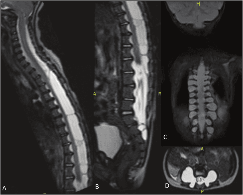 Imagem de RM sagital T2 da coluna mostrando ectasia dural toracolombar